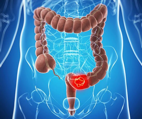SANTÉ · PRÉVENTION Cancer colorectal : 1 000 Ivoiriens dépistés gratuitement en deux semaines — l'État déclenche l'alerte précoce